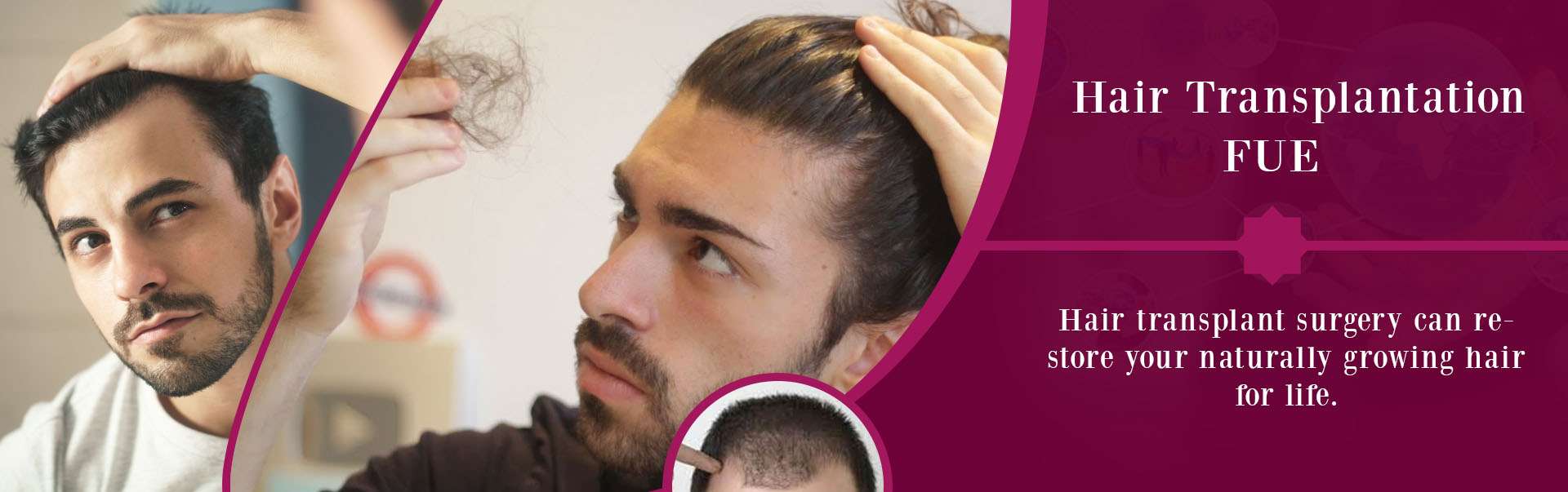  FUE Hair Transplant in Anand